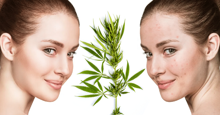 Le cannabidiol contre l’acné : une solution prometteuse? 2 Le cannabidiol contre l’acné : une solution prometteuse? 2