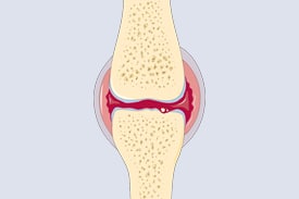 Soulager les symptômes de l'arthrite par le CBD ? 2 Soulager les symptômes de l'arthrite par le CBD ? 2
